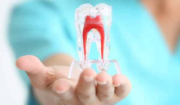 Root Canal Treatment (RCT) Painless in Chandigarh - Dental Lifeline