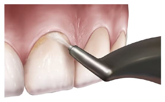 Sparkling Smiles Without the Scraping: Why Dental Air Polishing Might Be Your New Best Friend