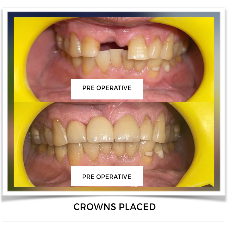 Crowns