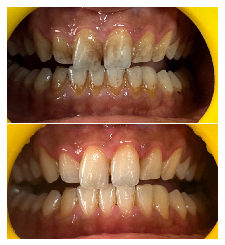 Dental Air Polishing