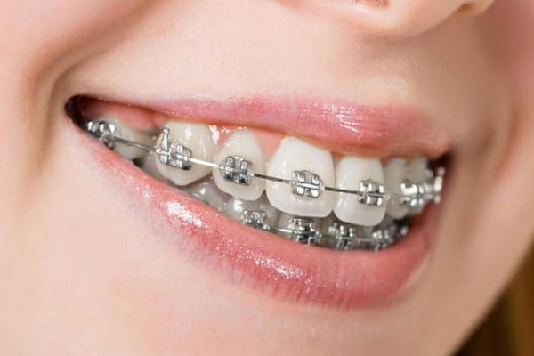 Invisalign Braces Cost in Chandigarh: How much do you need to invest?