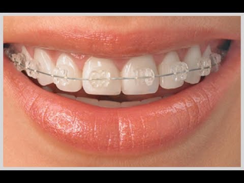 Invisalign Braces Cost in Chandigarh: How much do you need to invest?