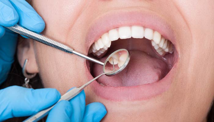 Wisdom Tooth Removal & Filling in Chandigarh - Dental Lifeline
