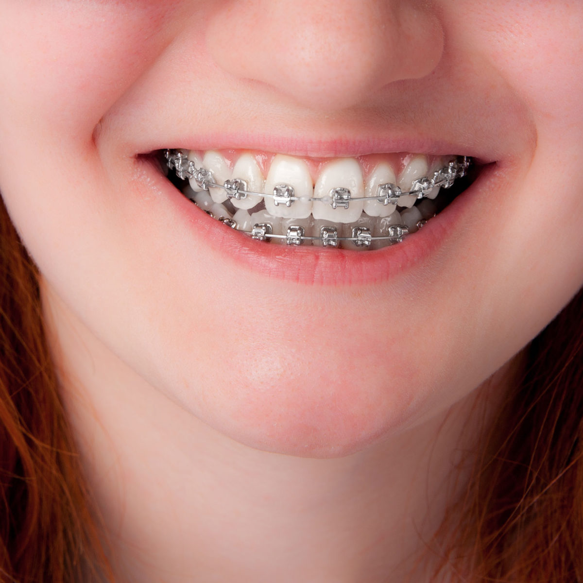 Dental Braces And Pediatric Dentistry: Everything You Need 