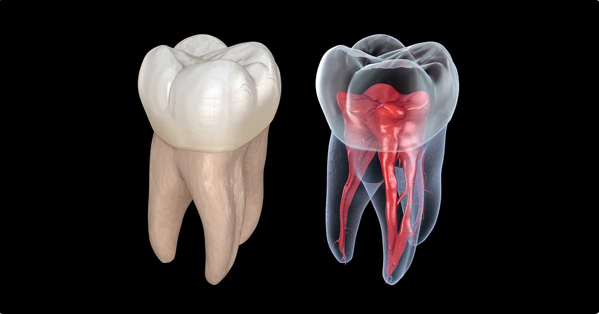 root-canal-treatment-rct-painless-in-chandigarh-dental-lifeline