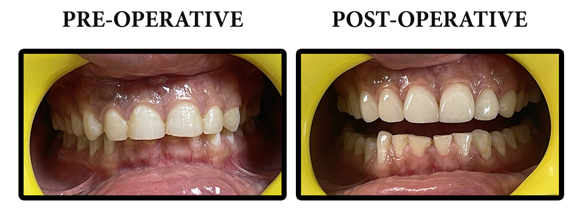 Dental-VENEERS