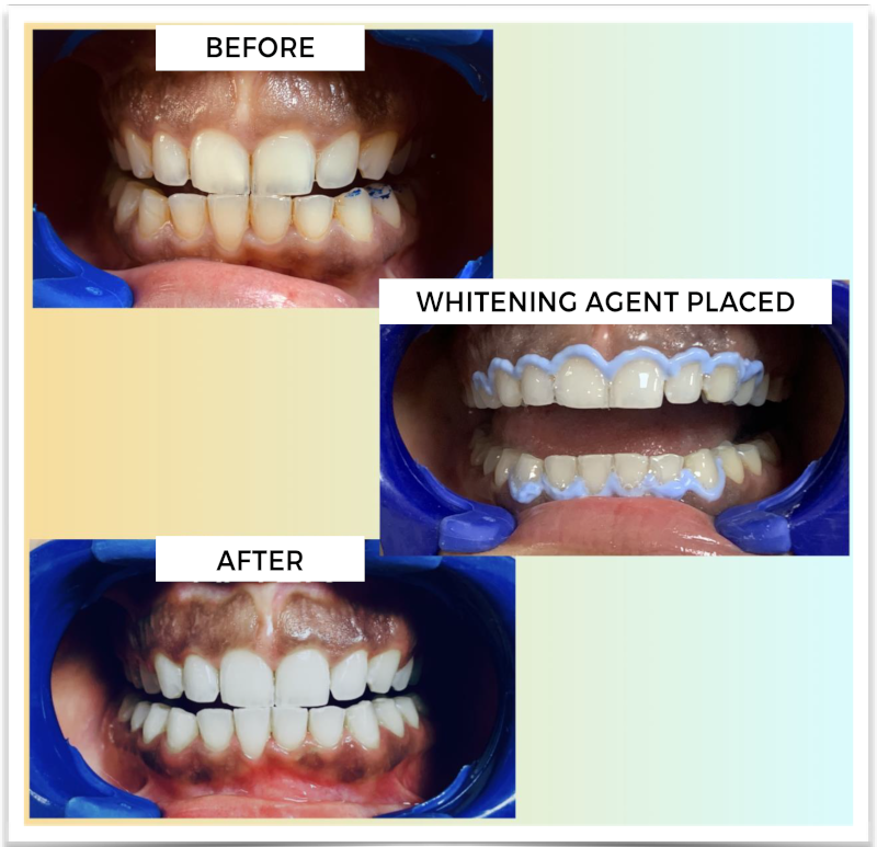 WHITENING AGENT PLACED