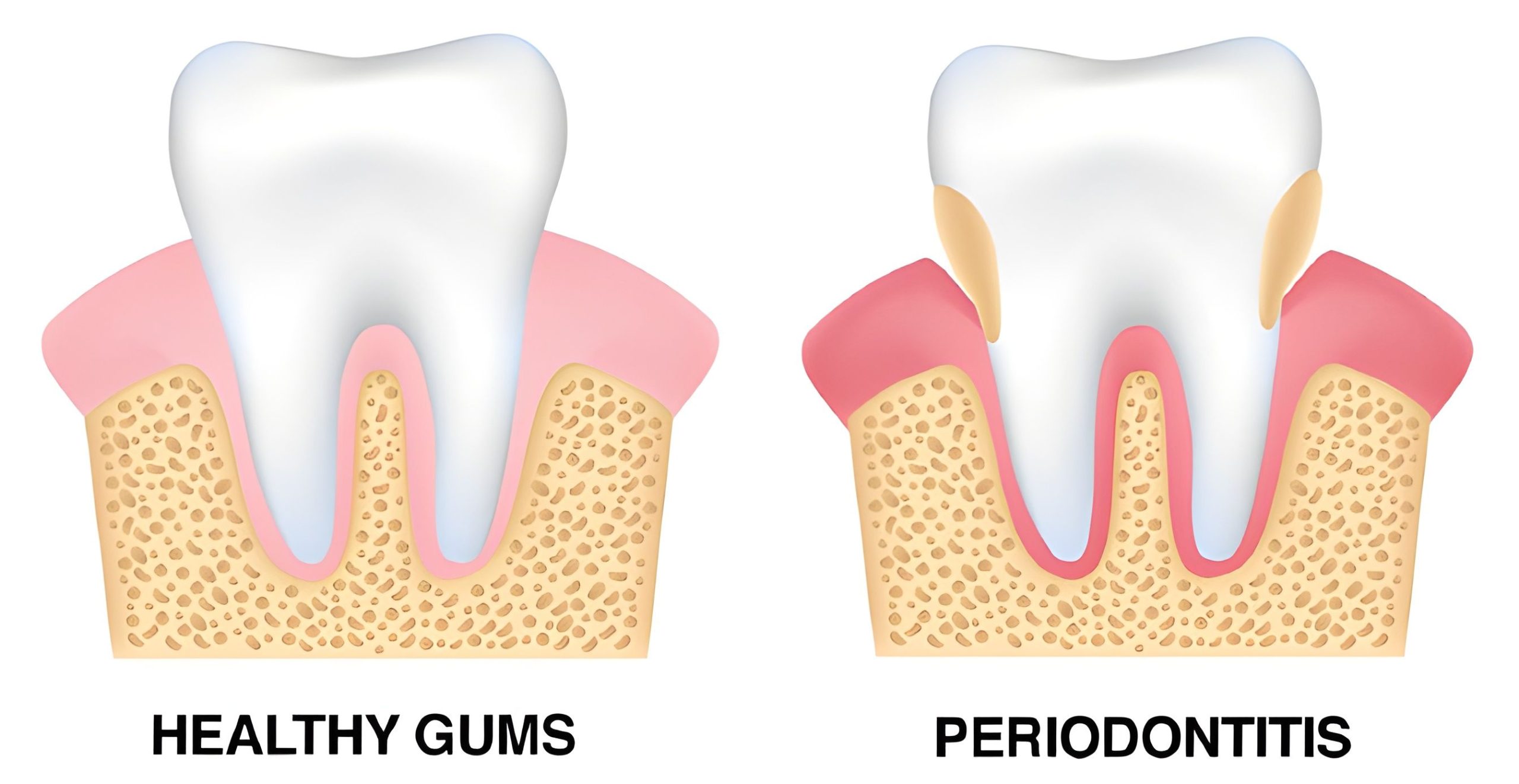 Periodontitis